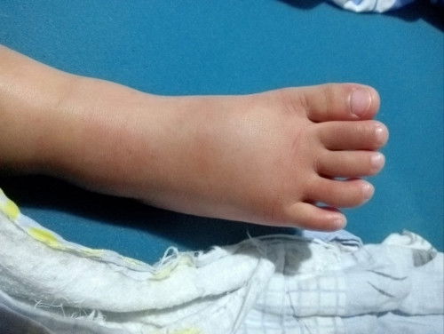 Namamaga ang paa ng anak Kong 2 yrs old Hindi alam kung kagat Ng insect