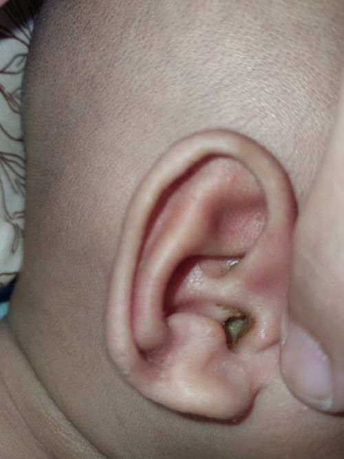 telinga keluar cairan