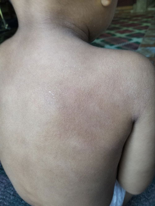 Bun. Adakah anknya punya keluhan kulit seperti ini? Ini pnyakit apa y?