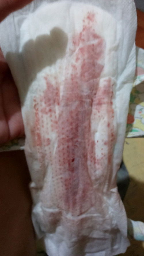 Bleeding 2 months preggy Mii sana po mapansin