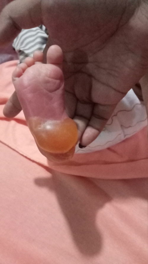 Bun anak ku di ambil darah (Skrining hipotiroid kongenital ) di usia 3hari .