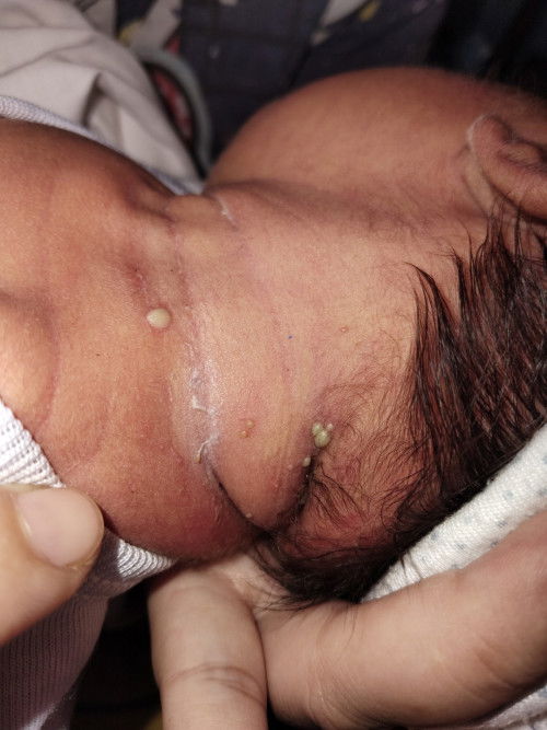 Butlig na may nana sa bag ong Silang na sanggol.