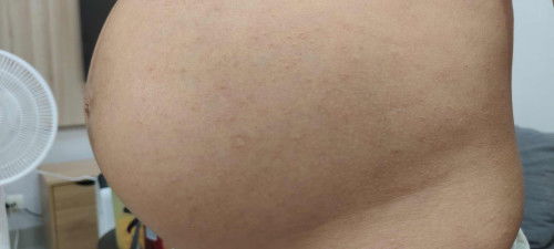 Perut dan kaki bintik2 merah seperti biang keringat di TM 3