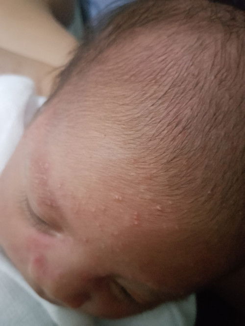 NEWBORN RASHES