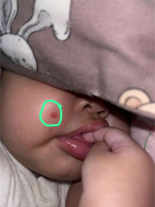 Bintik merah melebar