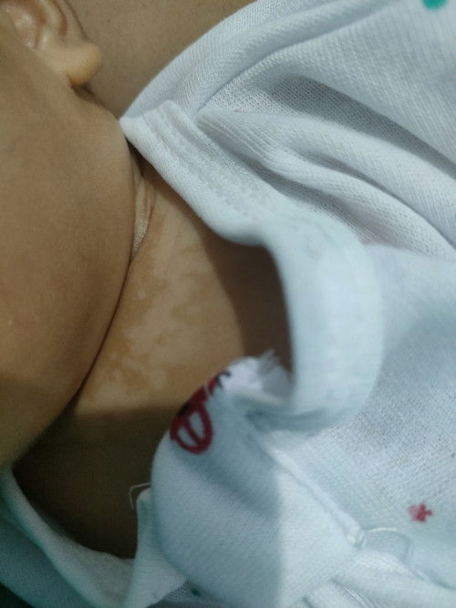 Bercak putih pada bayi 2bulan