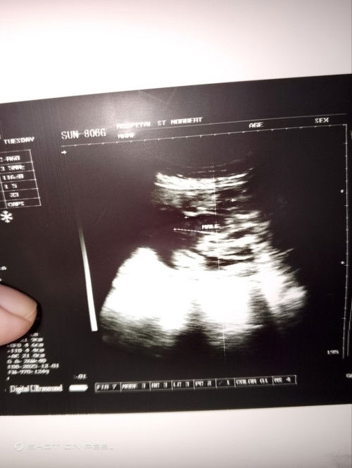 Sure po kaya na baby boy na itong ultrasound ko?