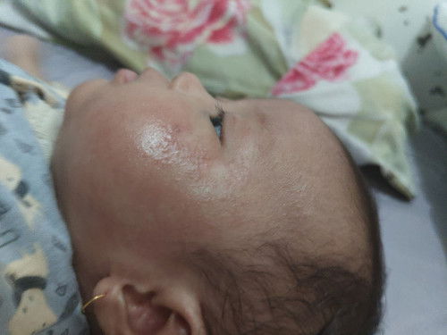 Kulit wajahnya bayi merah dan kering