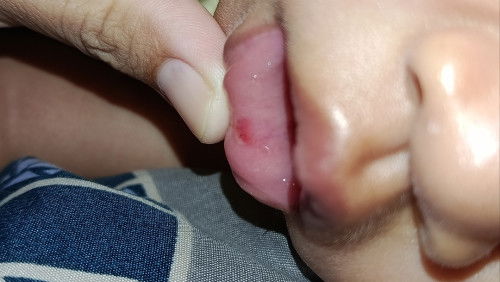 Mulut luka