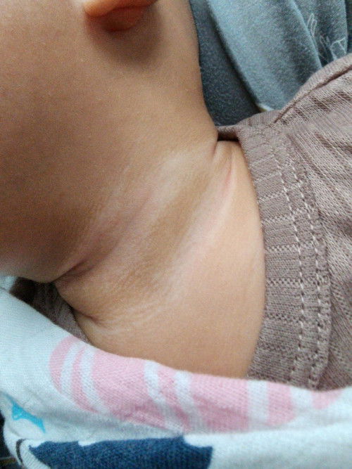 Mula² leher anak warna merah lepastu jadi macam ni. Biasa ke? Atau ada cara untuk merawat