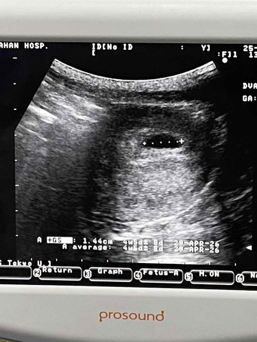 4 weeks แม่ๆ ซาวด์เจออะไรกันบ้างคะ