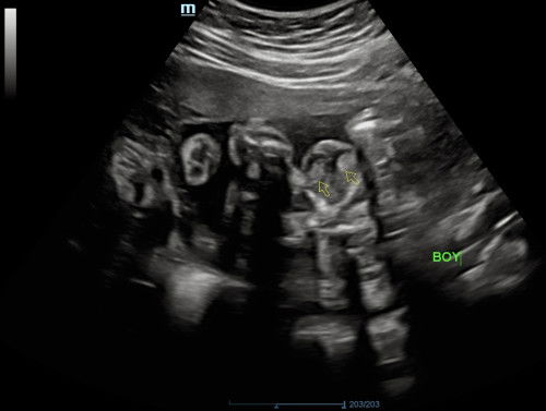 Gambar scan gender