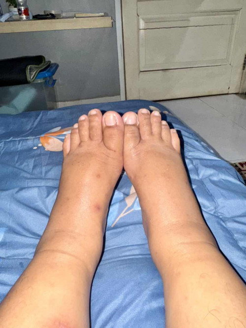 Kaki bengkak