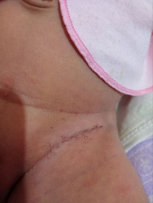 Yang anak nya pernah ngalamin ini di lipatan paha bayi 5 hari.
Blom dikasih apa2 takut ny makin prah