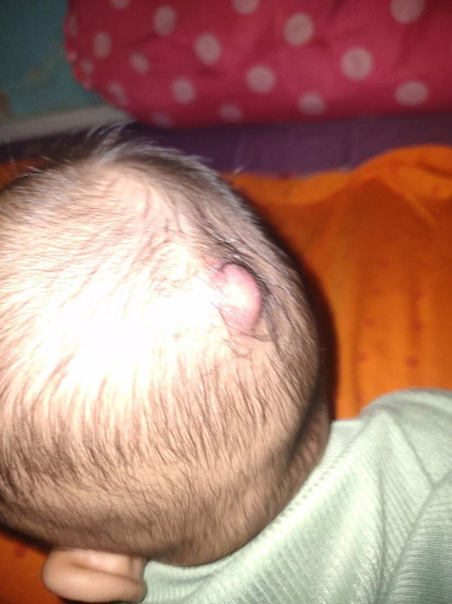 obat bisul alami pada kepala bayi 4 bulan apa ya, udah seminggu udah di salepin ga kmpes2