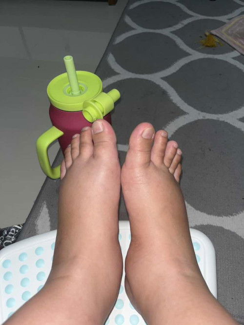 Kaki bengkak