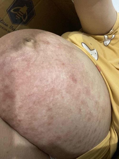 PPUP Rash!