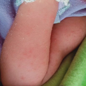 Hai Bun mau tanya buat ilang in bintik" Kya gni pke apa ya ??