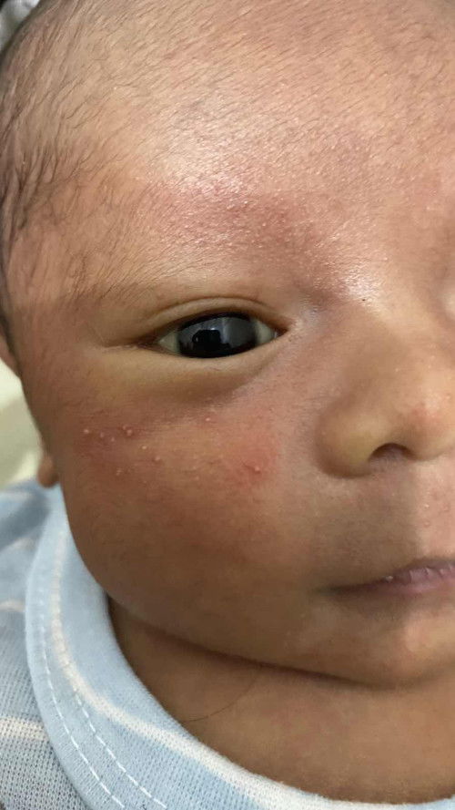 Bintik di muka baby