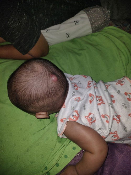 obat bisul pada bayi yang alami apa yaa