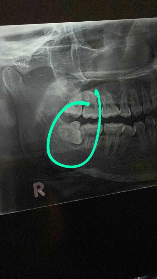 Cabut gigi bungsu impaksi