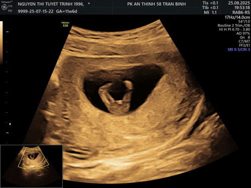 Các mom ơi siêu âm như này là gái hay trai ạ