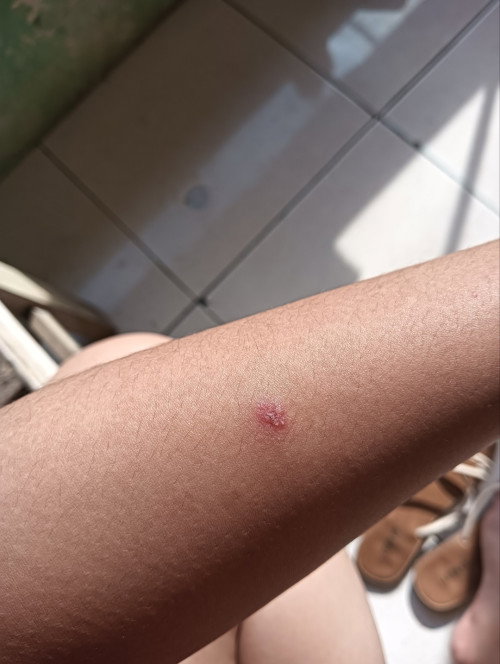 herpes atau apa?