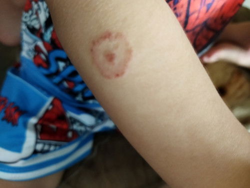 Các mẹ cho em hỏi bé nhà em bj bỏng đầu thuốc lá xong lành rồi bây giờ càng ngày càng lan rộng ra ạ