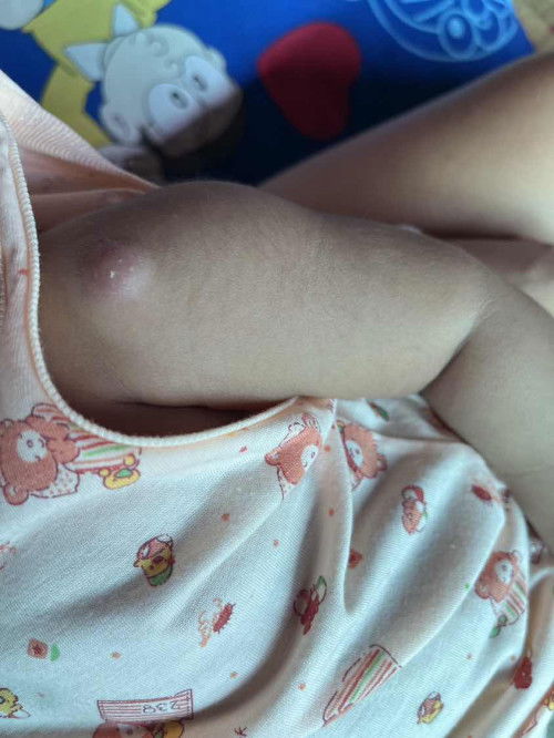 ฝีบวมแดงตอนลูกอายุ 2 เดือน