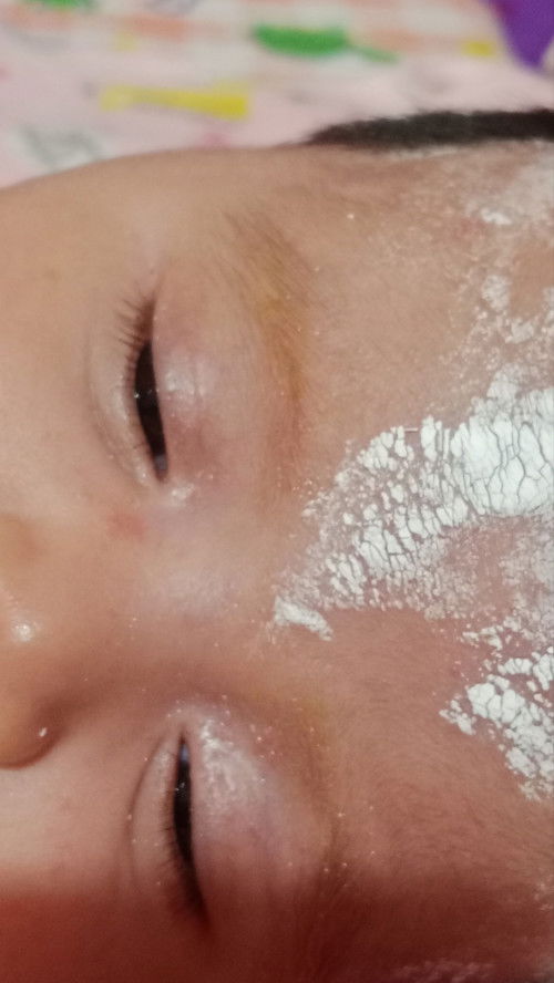 Urat biru di kelopak mata dan hidung