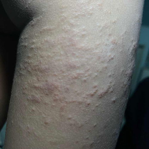ลูกเป็นผืนแดงอะไรมีใครรู้บ้างค่ะ