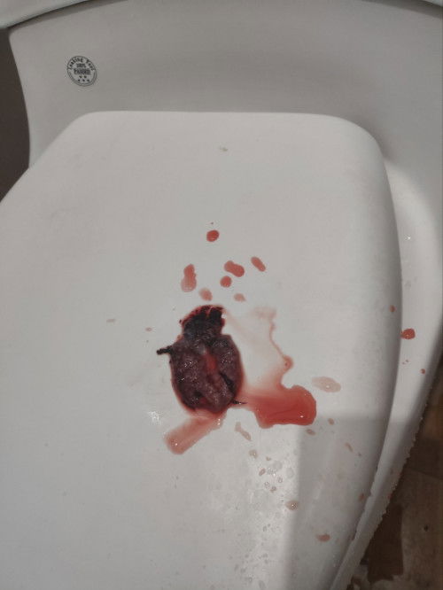 Bun mau tanya perna ada yang ngalamin ga bund aku usia kehamilan 8 mg tbtb perdarahan seperti haid