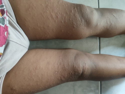 gatal gatal pada anak 2,5 tahun