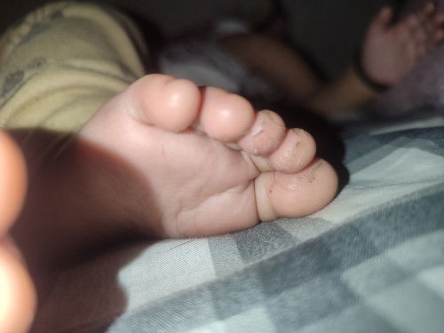 Kulit jari kaki & tangan mengelupas apa karena sering cuci tangan