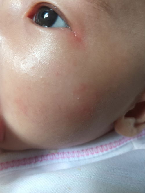 สอบถามเเม่ๆหน่อยค่ะ น้องมีผื่นเม็ดๆสีเเดงขึ้นที่เเก้ม เเต่เเปปๆหาย เป็นผื่นร้อน หรือ ผื่นเเพ้นมผงค่ะ