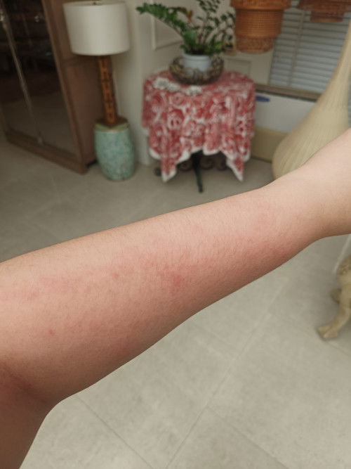 สอบถามเรื่องผื่นคัน