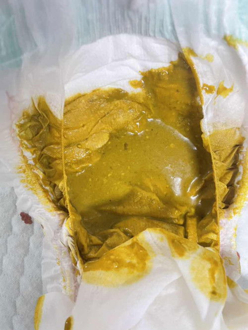 ลักษณะอึแบบนี้เข้าขั้นท้องเสียไหม