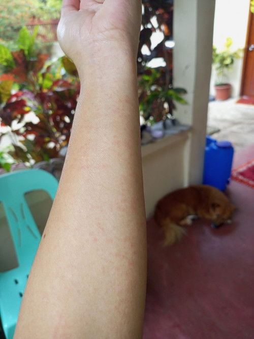 Skin Rashes during pregnancy