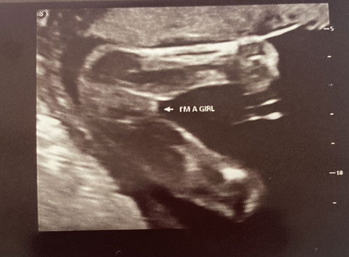 Gender baby