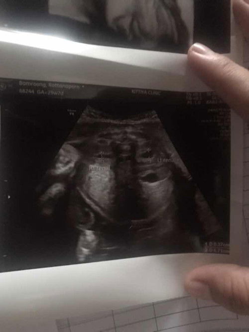29week2d มีโอกาสหายเองมั้ยค่ะ ไตบวม