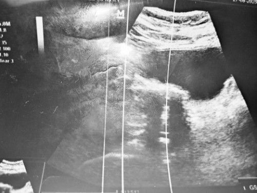 scan kehamilan 14 weeks blom dengar heartbeat,doc suh tunggu 2 week dtg scan smula tnye mne jnin@bby