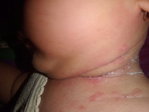 Kira-kira ini penyebabnya apa ya Bun dan obatnya apa