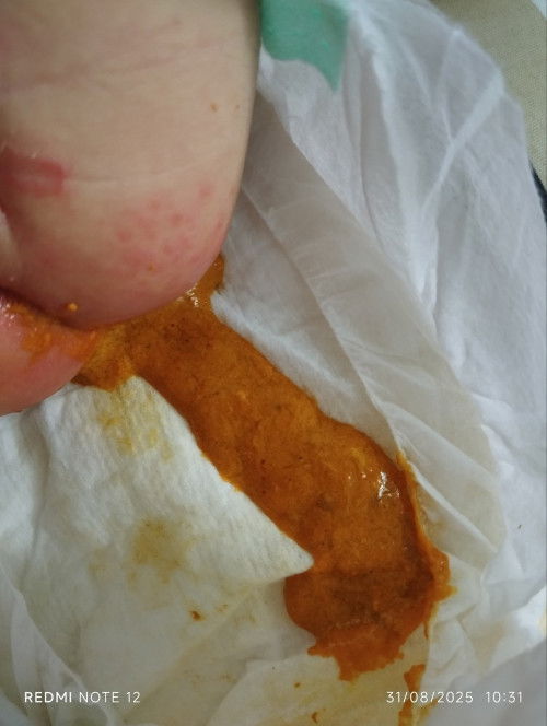 อึแบบนี้ปกติไหมคะ กินนมแม่