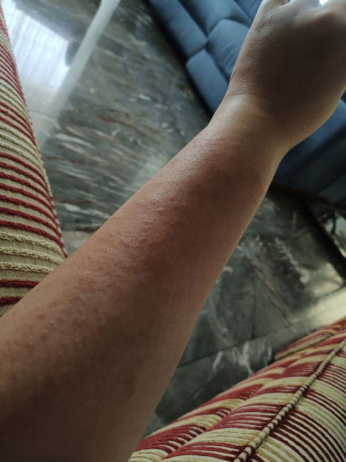 ผื่นขึ้นตอนท้อง 28 สัปดาห์