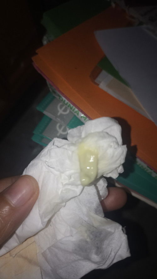 Keputihan kehijauan , gatal, tapi tidak berbau.