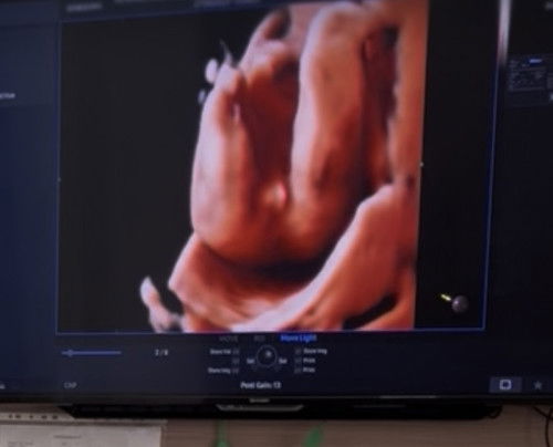Hasil USG JK 21weeks