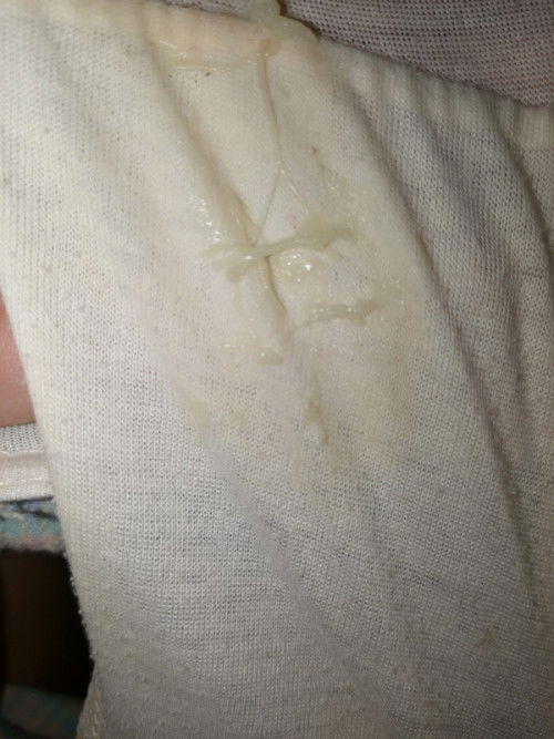 SUMILIM O NORMAL VAGINAL DISCHARGE?