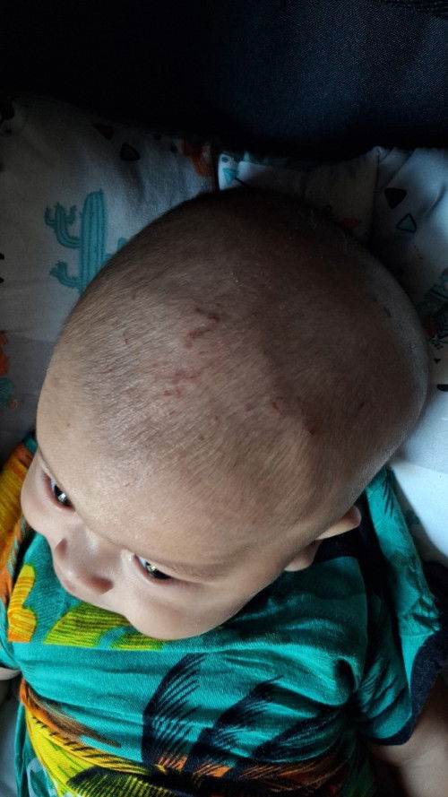 Kepala anak seperti benjol