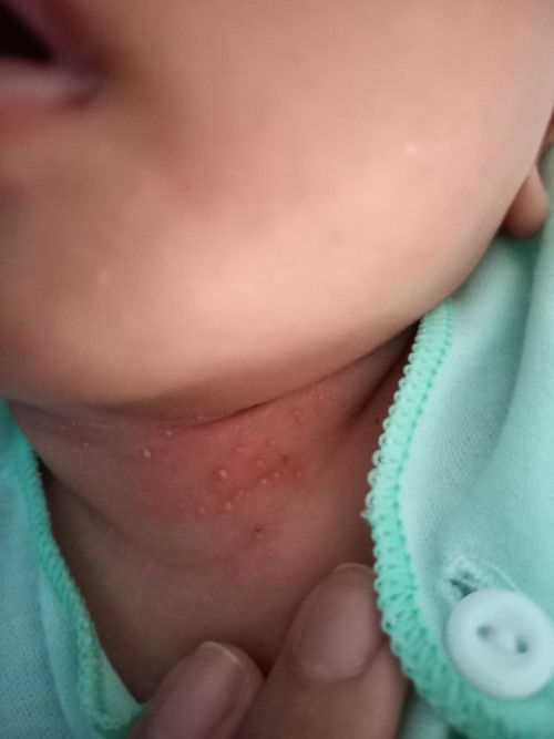 Bintik putih di leher
