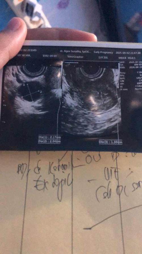 Hamil Ektopik di 7 week